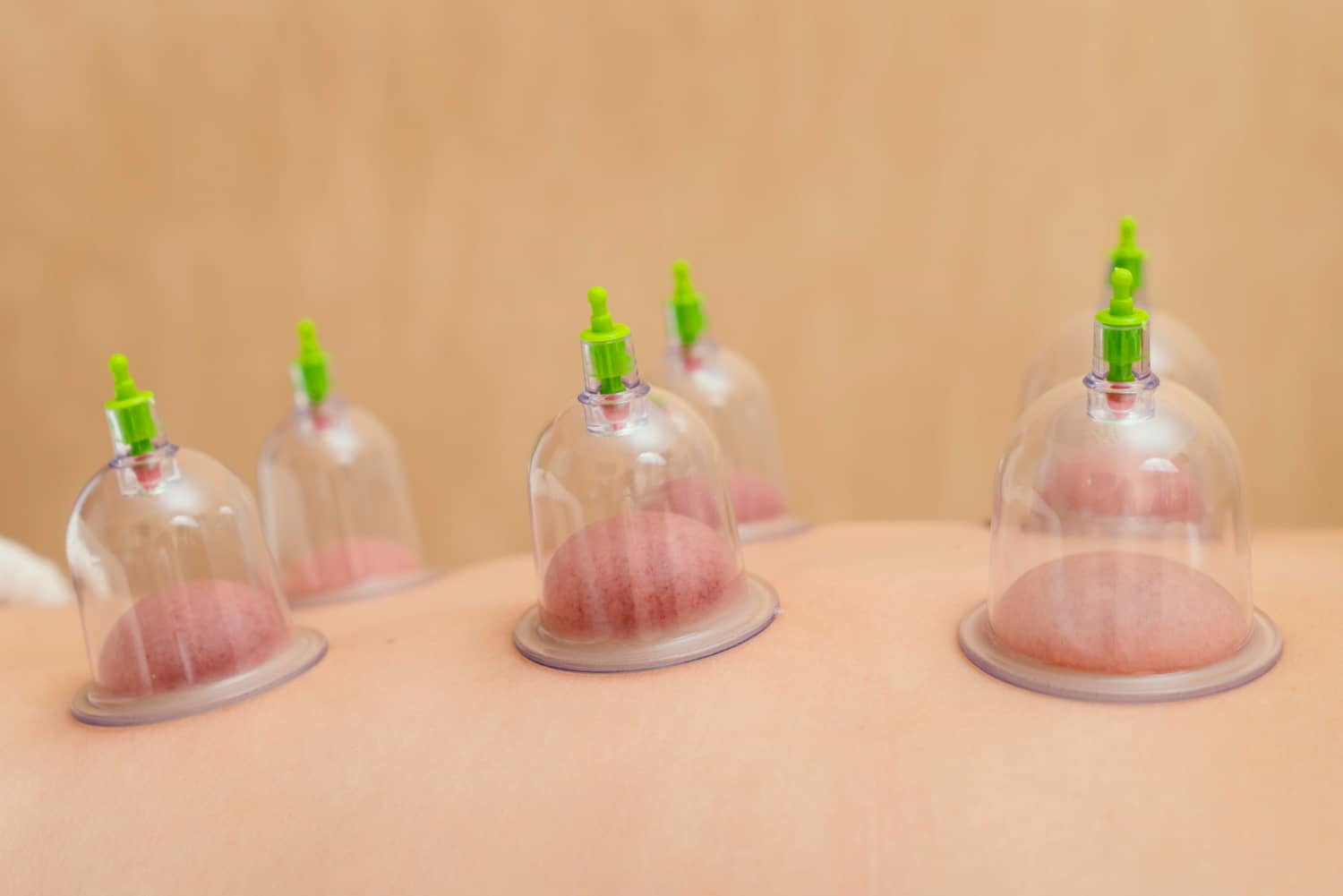 cupping-therapy-img