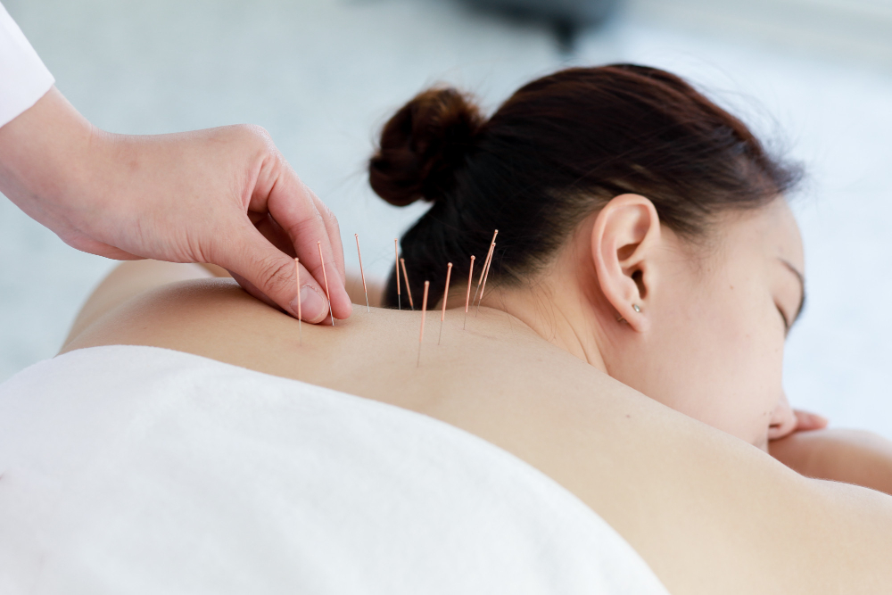 acupuncture treatments Willesden